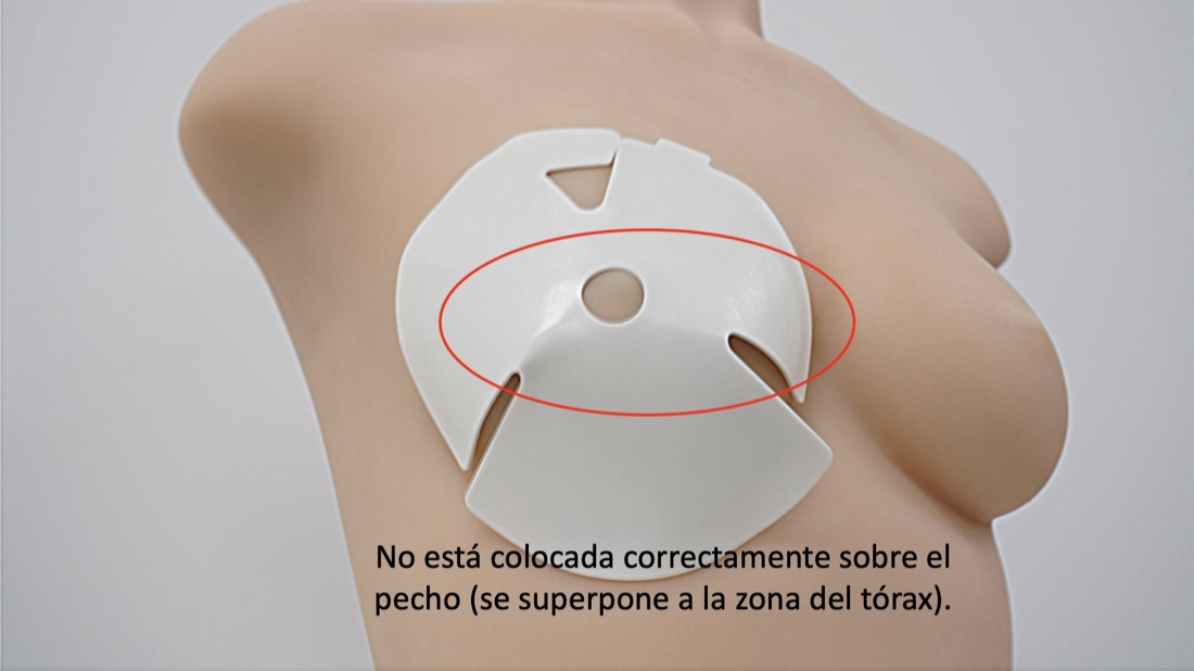 Parche desplazado hacia el tórax